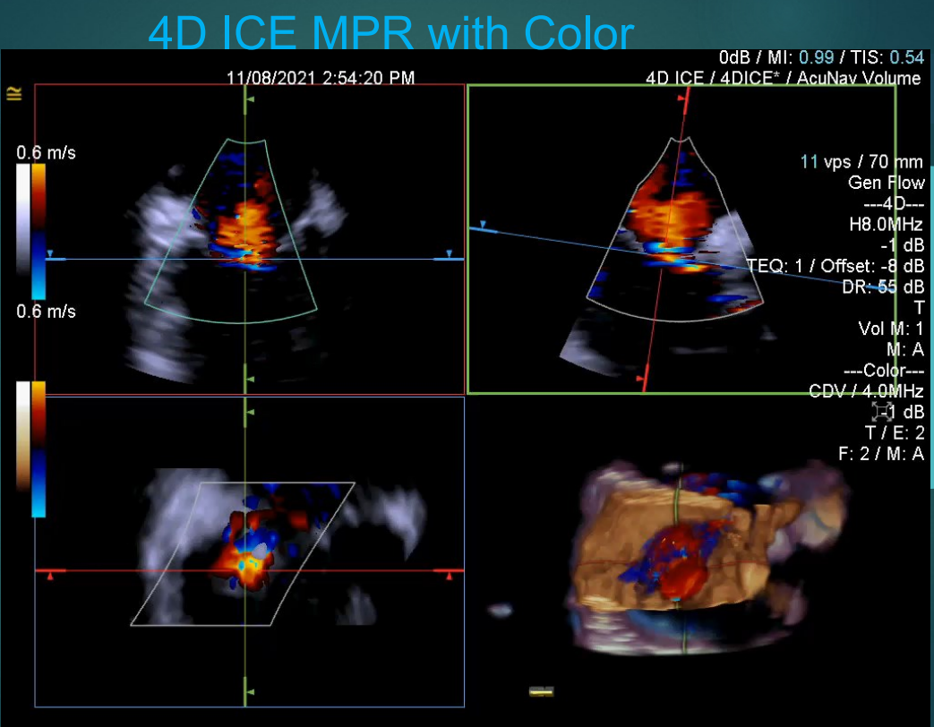術中超聲成像新技術|心腔內超聲（ICE）②市場研發(fā)篇